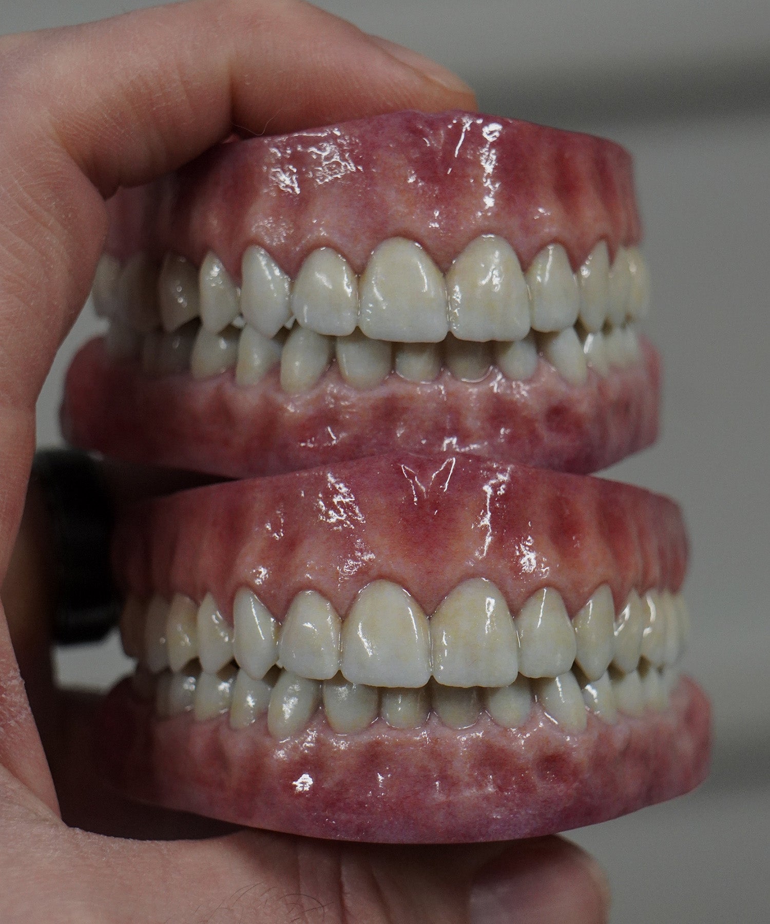 Pearly White Artificial Teeth Set (Reduced Maxillary and Mandibular Gum Line)